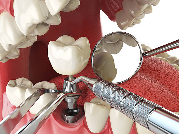 Best Emergency Root Canal Treatment in Youngsville, NC